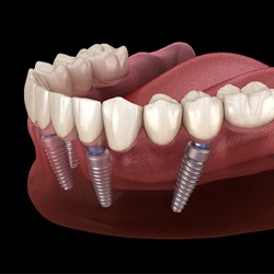 implant dentures in Westhampton