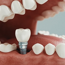 Diagram showing how dental implants in Westhampton are placed