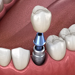 Diagram showing a single tooth dental implant in Westhampton