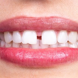 closeup of teeth with gaps  