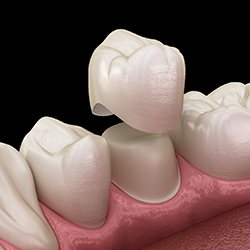 diagram of a dental crown