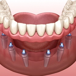 diagram of implant dentures in Westhampton