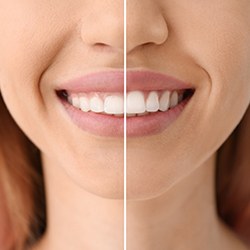 before and after photo of someone who did gum recontouring