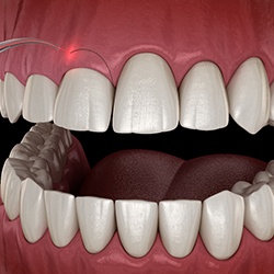 illustration of a soft tissue laser doing gum recontouring