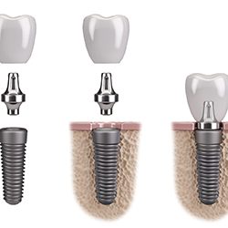parts and how dental implants work in Westhampton