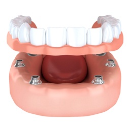 front view of implant dentures in Westhampton