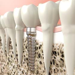 diagram of a dental implant in Westhampton