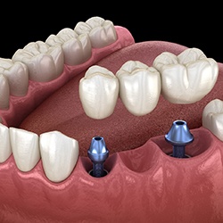 Diagram showing implant bridge replacing multiple missing teeth in Westhampton 