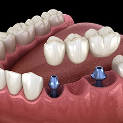 Diagram showing implant bridge replacing multiple missing teeth in Westhampton