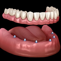 Diagram showing implant dentures in Westhampton