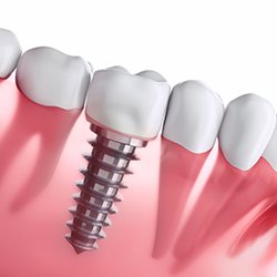 Diagram of how dental implants in Westhampton work
