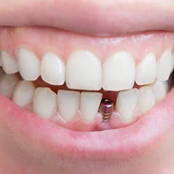 Closeup of patient with dental implant in Westhampton during osseointegration