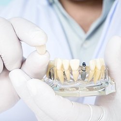 Westhampton implant dentist holding restoration and model jaw