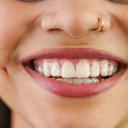 closeup of a woman wearing Invisalign