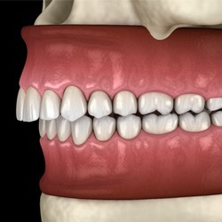 sideview of a diagram of an overbite   