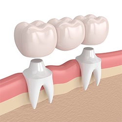 Animated dental bridge