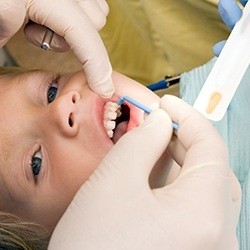 Child receiving fluoride treatment