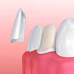 Animation of porcelain veneer placement