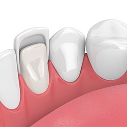 porcelain veneer tooth