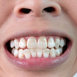 teeth with white spots