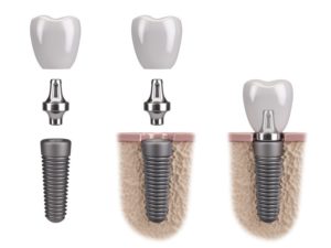 parts of dental implant