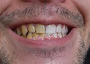 yellow to white teeth with a dentist in Westhampton