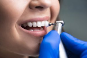 patient having their teeth professionally cleaned