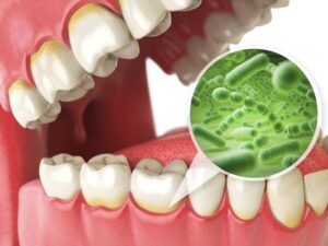 diagram of teeth and gums with microscopic bacteria